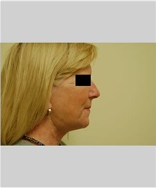 Facelift After Photo by Thomas Zewert, MD, PhD; Monterey, CA - Case 36672