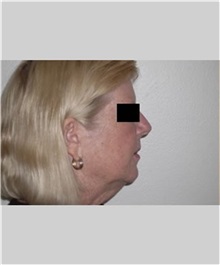 Facelift Before Photo by Thomas Zewert, MD, PhD; Monterey, CA - Case 36672