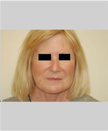 Facelift After Photo by Thomas Zewert, MD, PhD; Monterey, CA - Case 36672