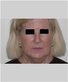 Facelift Before Photo by Thomas Zewert, MD, PhD; Monterey, CA - Case 36672