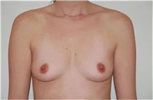 Breast Augmentation Before Photo by Thomas Zewert, MD, PhD; Monterey, CA - Case 37243