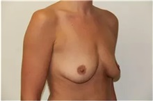 Breast Augmentation Before Photo by Thomas Zewert, MD, PhD; Monterey, CA - Case 37246