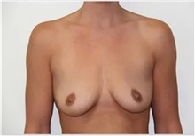 Breast Augmentation Before Photo by Thomas Zewert, MD, PhD; Monterey, CA - Case 37246