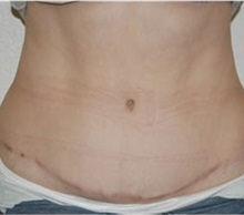 Tummy Tuck After Photo by Thomas Zewert, MD, PhD; Monterey, CA - Case 37249