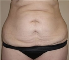 Tummy Tuck Before Photo by Thomas Zewert, MD, PhD; Monterey, CA - Case 37249