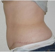 Tummy Tuck After Photo by Thomas Zewert, MD, PhD; Monterey, CA - Case 37249