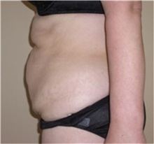 Tummy Tuck Before Photo by Thomas Zewert, MD, PhD; Monterey, CA - Case 37249