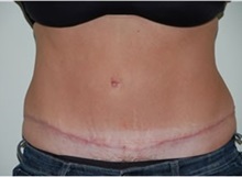 Tummy Tuck After Photo by Thomas Zewert, MD, PhD; Monterey, CA - Case 37250