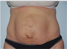 Tummy Tuck Before Photo by Thomas Zewert, MD, PhD; Monterey, CA - Case 37250