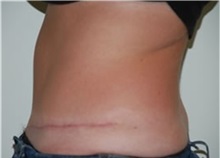 Tummy Tuck After Photo by Thomas Zewert, MD, PhD; Monterey, CA - Case 37250