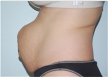 Tummy Tuck Before Photo by Thomas Zewert, MD, PhD; Monterey, CA - Case 37250