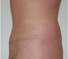 Tummy Tuck After Photo by Thomas Zewert, MD, PhD; Monterey, CA - Case 37251