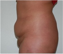 Tummy Tuck Before Photo by Thomas Zewert, MD, PhD; Monterey, CA - Case 37251