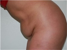 Tummy Tuck Before Photo by Thomas Zewert, MD, PhD; Monterey, CA - Case 37251
