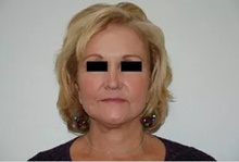 Facelift After Photo by Thomas Zewert, MD, PhD; Monterey, CA - Case 42004