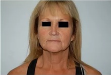 Facelift Before Photo by Thomas Zewert, MD, PhD; Monterey, CA - Case 42004