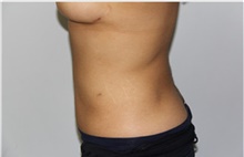 Liposuction After Photo by Thomas Zewert, MD, PhD; Monterey, CA - Case 42579