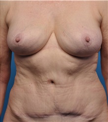 Breast Implant Removal After Photo by Lisa Cassileth, MD; Beverly Hills, CA - Case 34142