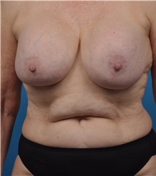 Breast Implant Removal Before Photo by Lisa Cassileth, MD; Beverly Hills, CA - Case 34142