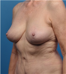 Breast Implant Removal After Photo by Lisa Cassileth, MD; Beverly Hills, CA - Case 34142