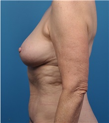 Breast Implant Removal After Photo by Lisa Cassileth, MD; Beverly Hills, CA - Case 34142