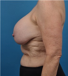 Breast Implant Removal Before Photo by Lisa Cassileth, MD; Beverly Hills, CA - Case 34142