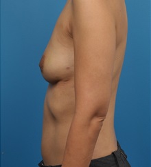 Breast Implant Removal After Photo by Lisa Cassileth, MD; Beverly Hills, CA - Case 34144