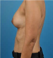 Breast Implant Removal Before Photo by Lisa Cassileth, MD; Beverly Hills, CA - Case 34144
