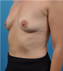 Breast Augmentation Before Photo by Lisa Cassileth, MD; Beverly Hills, CA - Case 34174