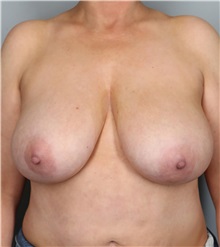 Breast Reduction Before Photo by Lisa Cassileth, MD; Beverly Hills, CA - Case 50553