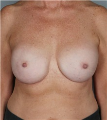 Breast Reconstruction After Photo by Lisa Cassileth, MD; Beverly Hills, CA - Case 50554