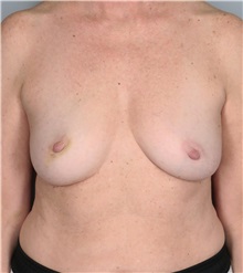 Breast Reconstruction Before Photo by Lisa Cassileth, MD; Beverly Hills, CA - Case 50554