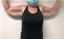 Arm Lift Before Photo by Gudjon Gunnarsson, MD; Reykjavik,  - Case 49233