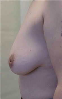 Breast Lift Before Photo by Gudjon Gunnarsson, MD; Skien,  - Case 49259