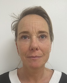 Facelift After Photo by Gudjon Gunnarsson, MD; Skien,  - Case 50639