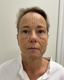 Facelift Before Photo by Gudjon Gunnarsson, MD; Skien,  - Case 50639
