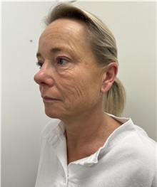 Facelift Before Photo by Gudjon Gunnarsson, MD; Skien,  - Case 50639