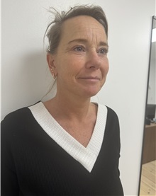 Facelift After Photo by Gudjon Gunnarsson, MD; Skien,  - Case 50639