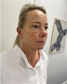 Facelift Before Photo by Gudjon Gunnarsson, MD; Skien,  - Case 50639