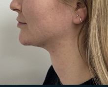 Chin Surgery After Photo by Gudjon Gunnarsson, MD; Skien,  - Case 50637