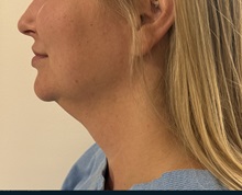 Chin Surgery Before Photo by Gudjon Gunnarsson, MD; Skien,  - Case 50637