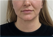Chin Surgery After Photo by Gudjon Gunnarsson, MD; Skien,  - Case 50637