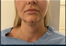Chin Surgery Before Photo by Gudjon Gunnarsson, MD; Skien,  - Case 50637