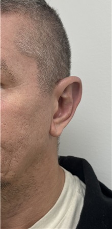 Ear Surgery After Photo by Gudjon Gunnarsson, MD; Skien,  - Case 50638