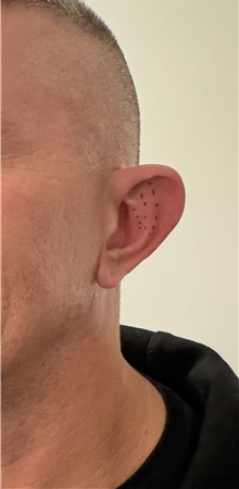 Ear Surgery Before Photo by Gudjon Gunnarsson, MD; Skien,  - Case 50638