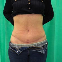 Tummy Tuck After Photo by Gudjon Gunnarsson, MD; Skien,  - Case 50640