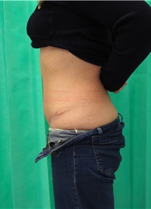 Tummy Tuck After Photo by Gudjon Gunnarsson, MD; Skien,  - Case 50640