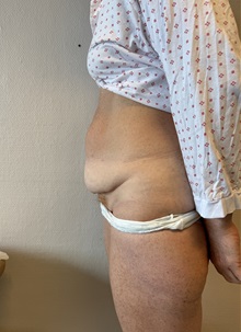 Tummy Tuck Before Photo by Gudjon Gunnarsson, MD; Skien,  - Case 50640