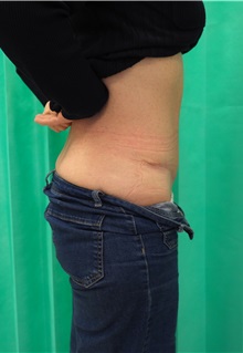 Tummy Tuck After Photo by Gudjon Gunnarsson, MD; Skien,  - Case 50640
