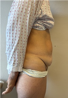 Tummy Tuck Before Photo by Gudjon Gunnarsson, MD; Skien,  - Case 50640